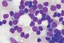 B Tipi Lenfoma Belirtileri ve Tedavisi