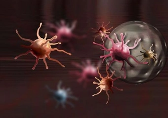 Hodgkin Lenfoma 3 Evre