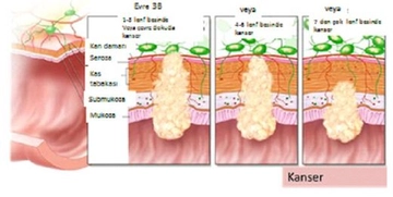 Lenfoma 3 Evre Semptomları