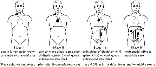Hodgkin Lenfoma Evreleri